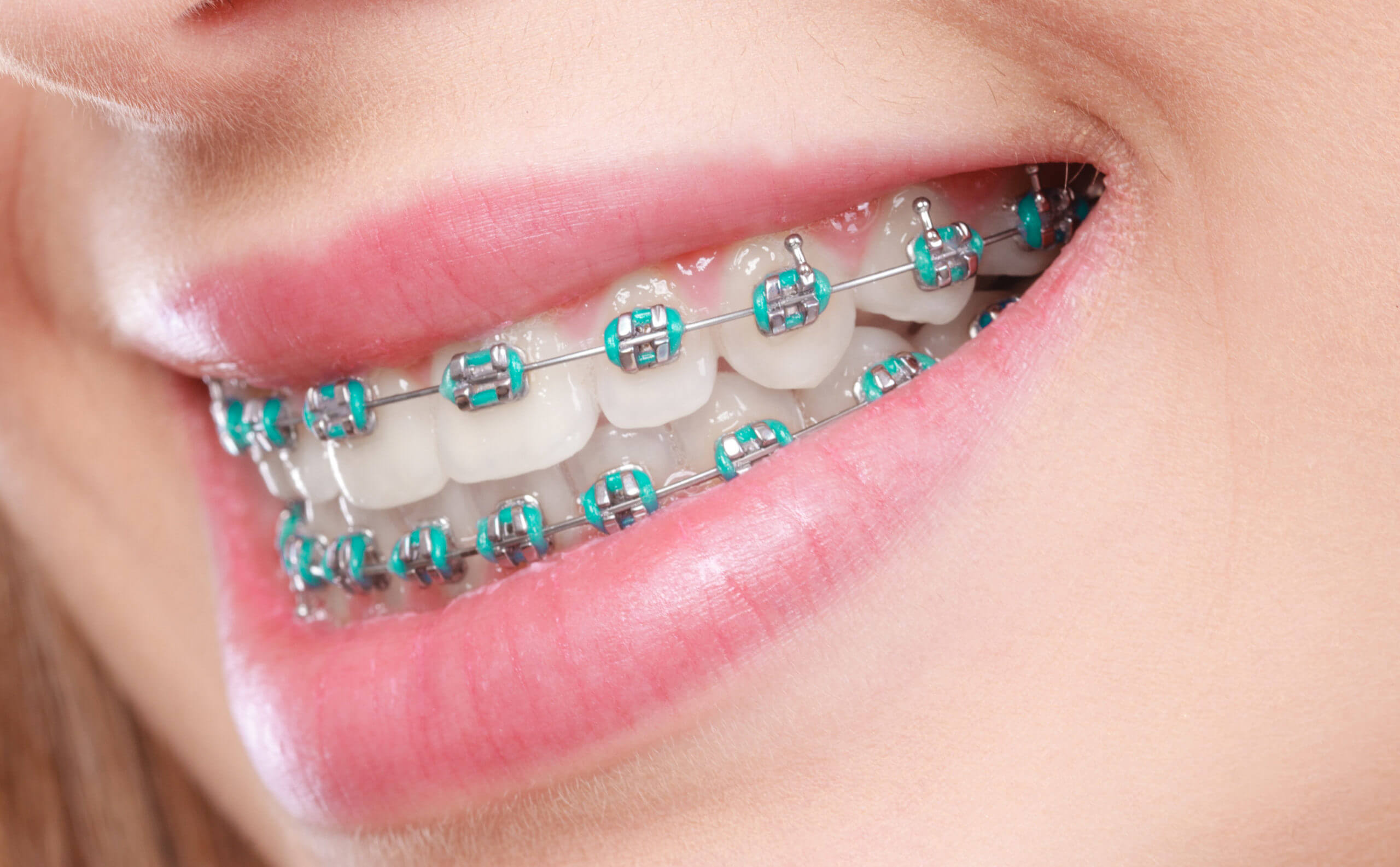 Removable Braces for Adults UK: Invisalign & Clear Aligners Guide