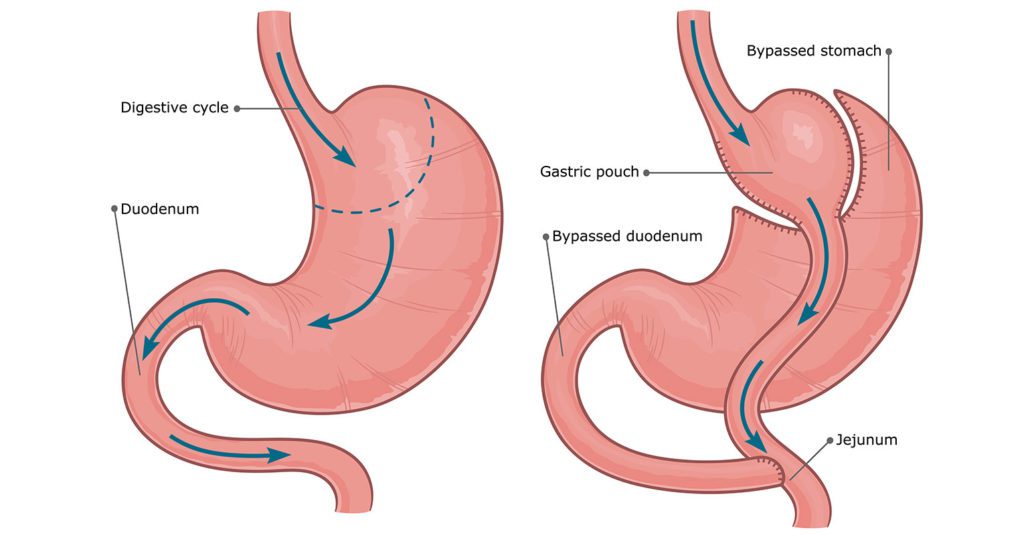 Gastric Bypass Surgery: Eligibility, Procedure, Benefits & Risks Guide