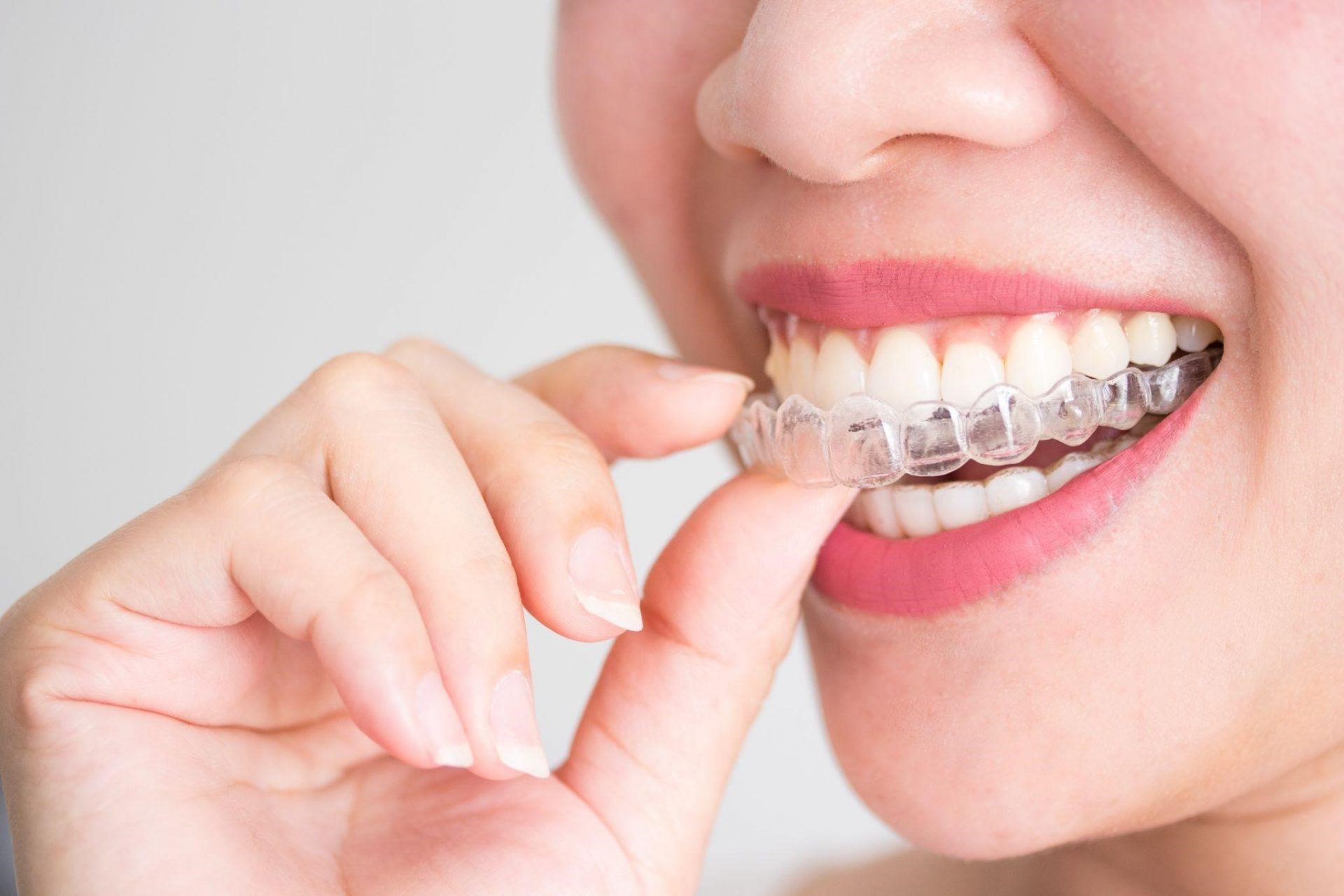 Invisible Teeth Aligners Guide: Costs, Benefits, and What's Next