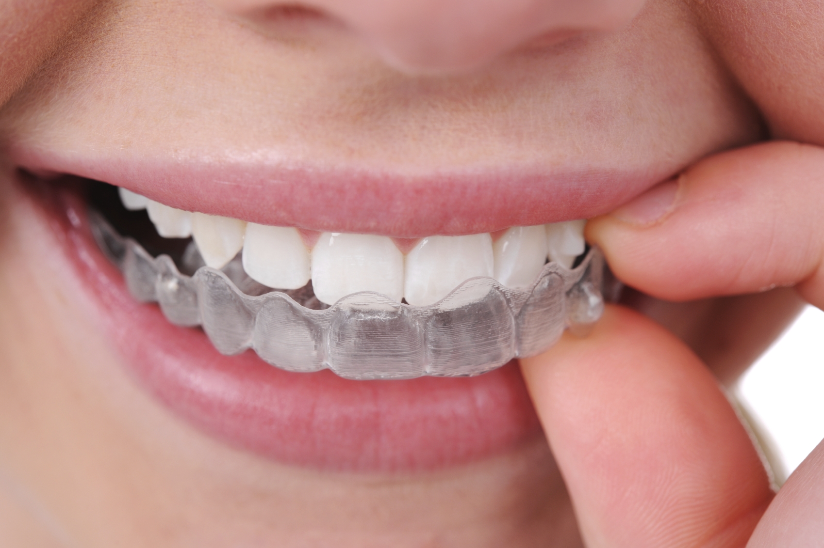 UK Braces & Dental Splints Guide: Types, Costs, & Latest Innovations