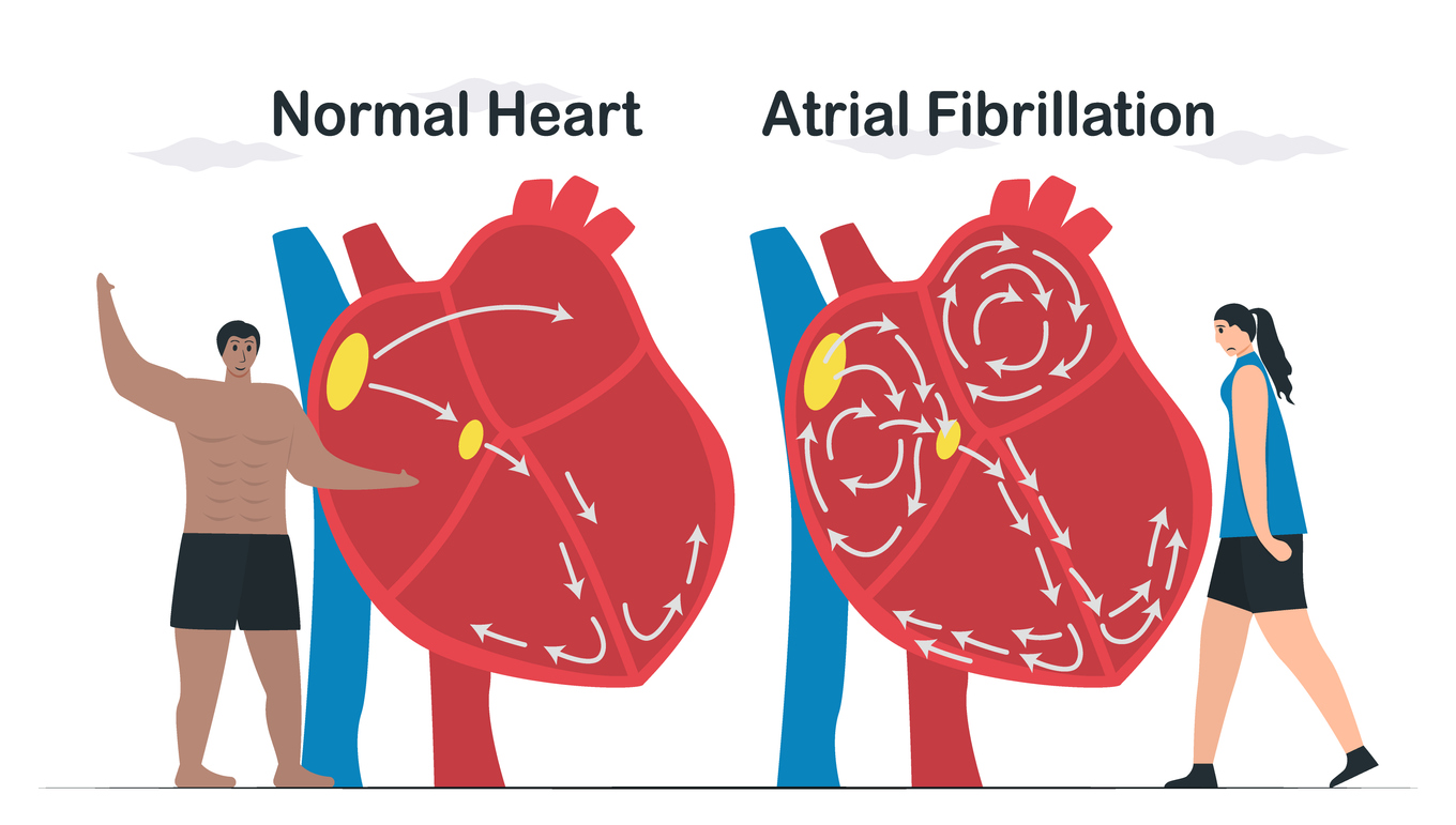 Atrial Fibrillation Guide: Symptoms, Triggers, Prevention & Treatment