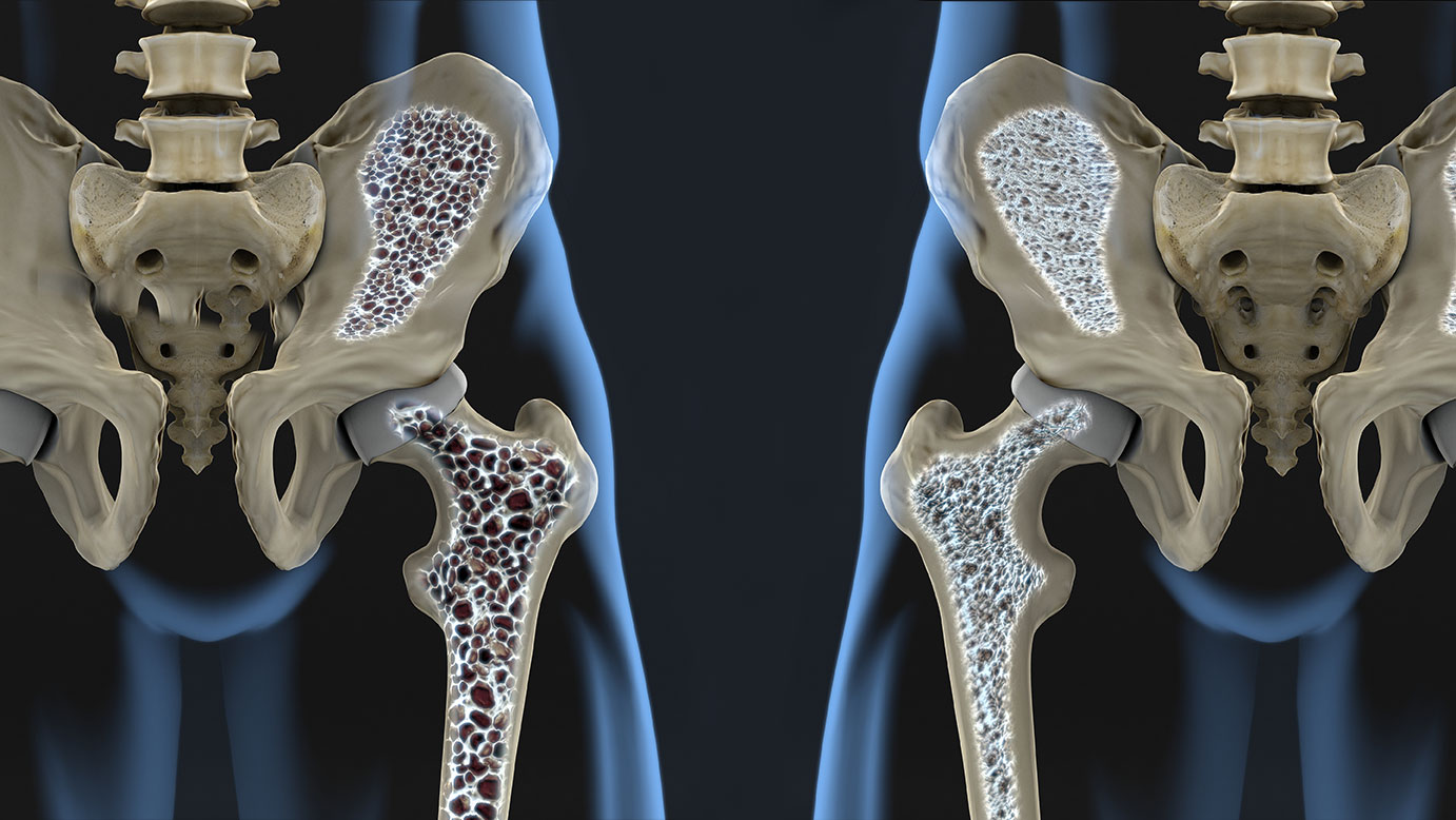 Complete Guide to Bone Density: Prevention, Treatments & Expert Advice