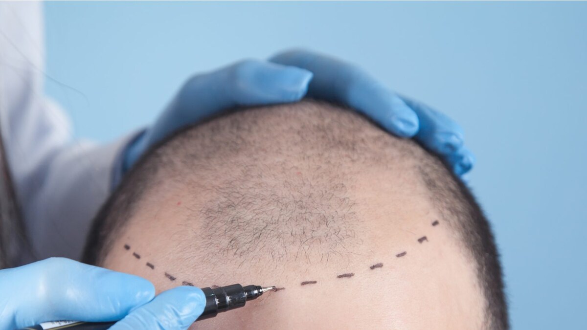 Haartransplantation in Deutschland: Kosten, Methoden, Kliniken – Umfassender Ratgeber