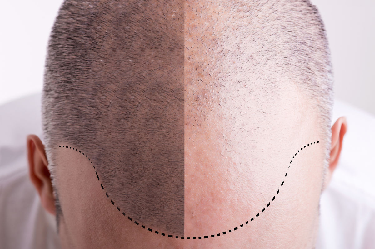 Hair Transplant UK 2024: FUE vs FUT Costs, City Prices & Clinic Guide