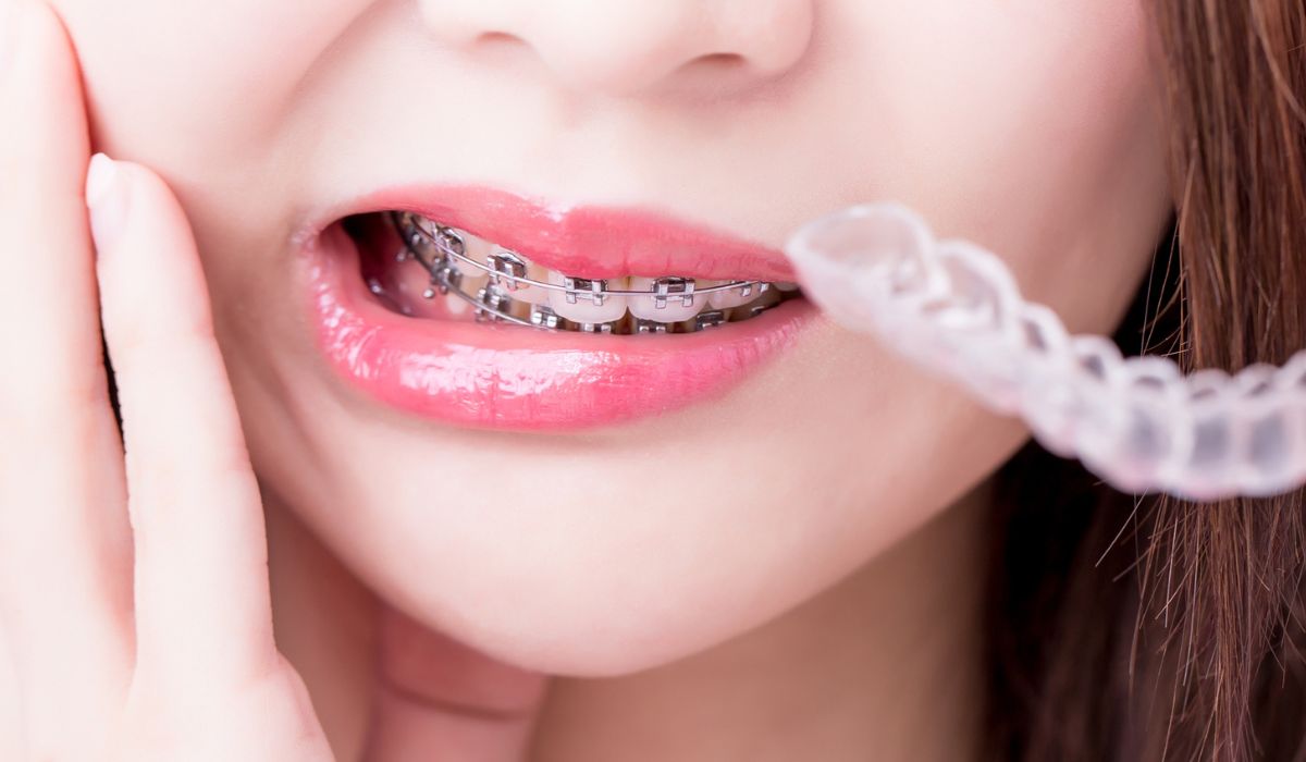 US Braces Guide 2025: Metal, Ceramic, Aligners – Costs & Treatment