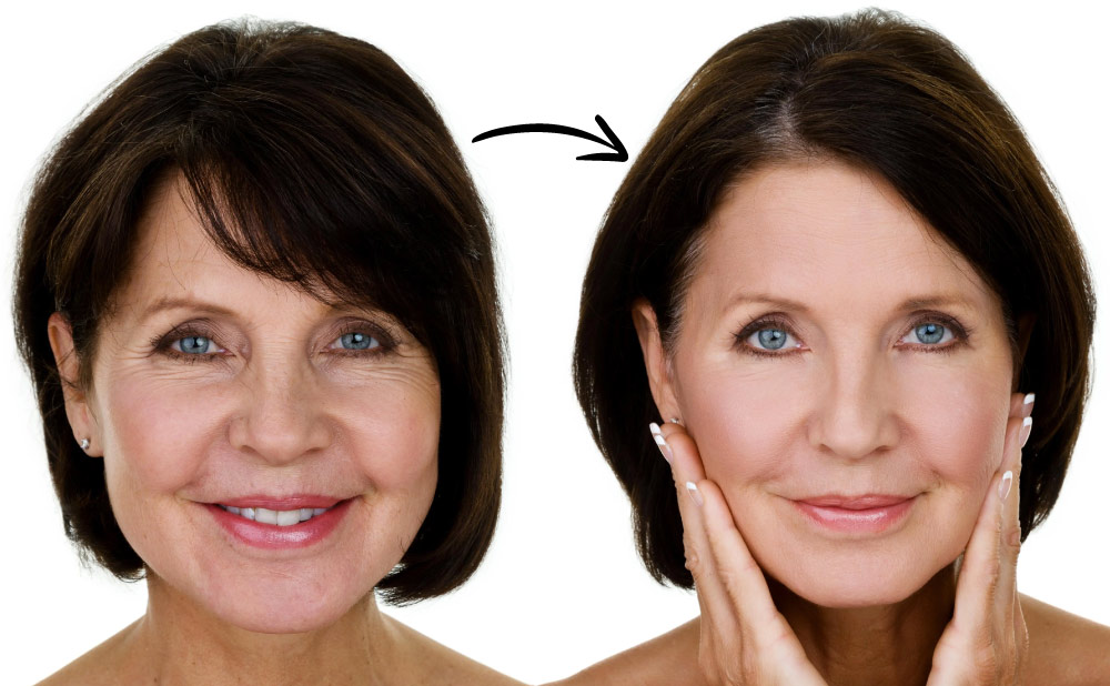 Rejuvenecimiento facial: lifting quirúrgico y alternativas no invasivas