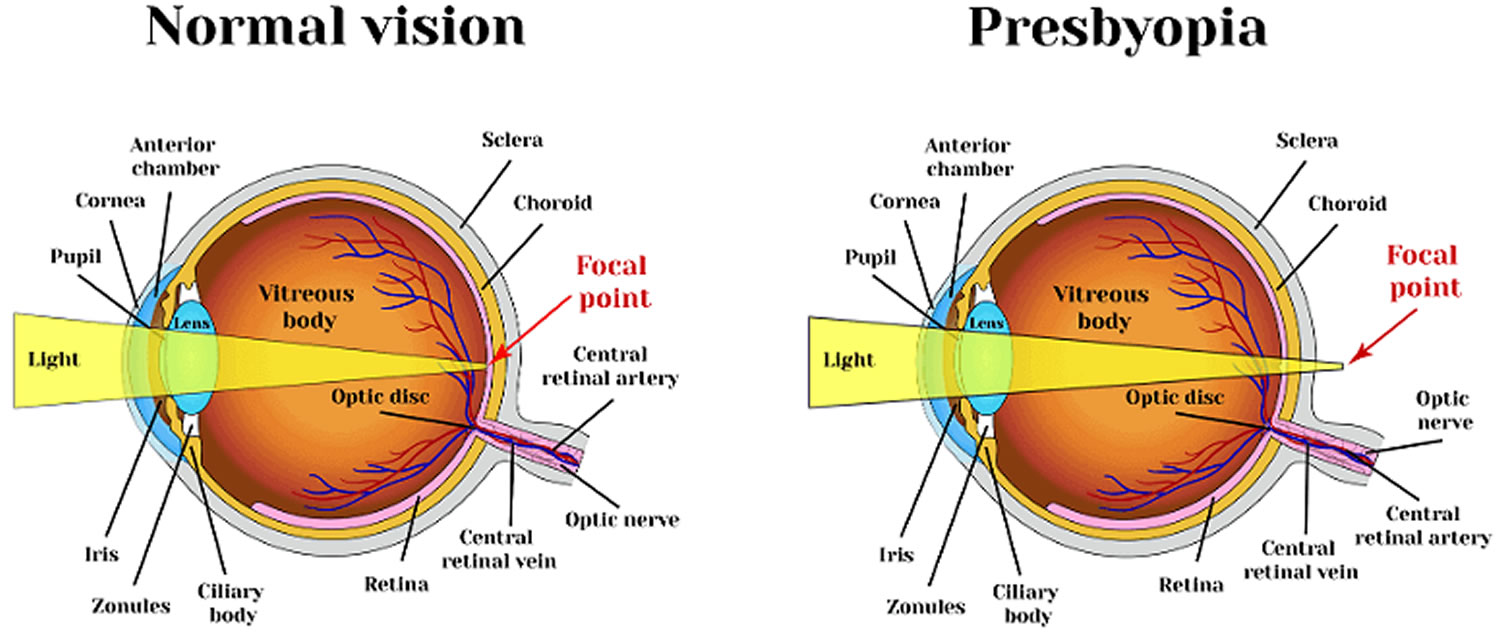 Presbyopia Treatment Guide: Eyeglasses, Contacts, Surgery & Eye Drops