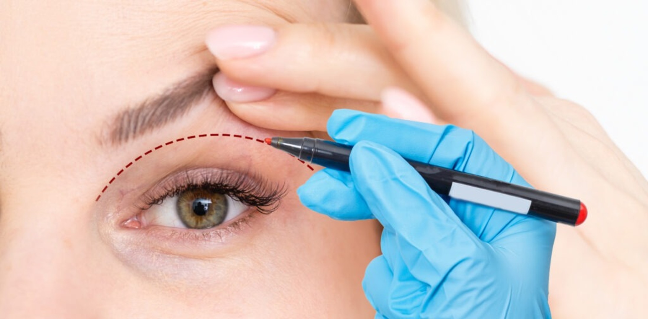 Blefaroplastia con láser: rejuvenece tu mirada de forma natural y rápida