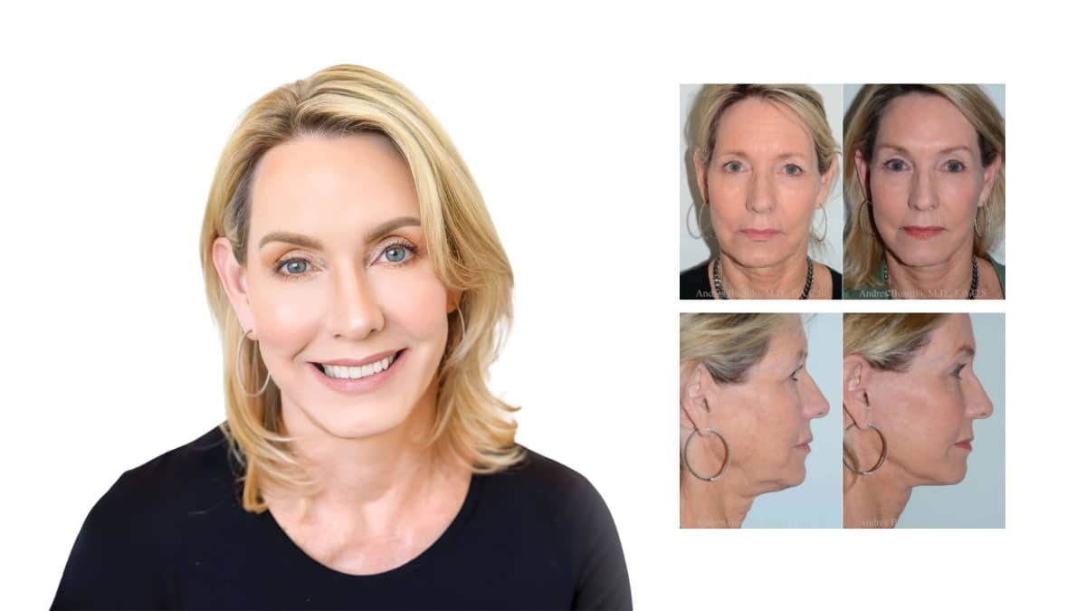 2025 Facelift Guide: Natural Rejuvenation, Costs & Minimally Invasive Options