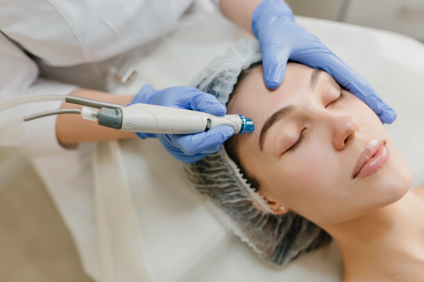 Microneedling : guide complet sur les bienfaits, le déroulement et les résultats pour une peau transformée