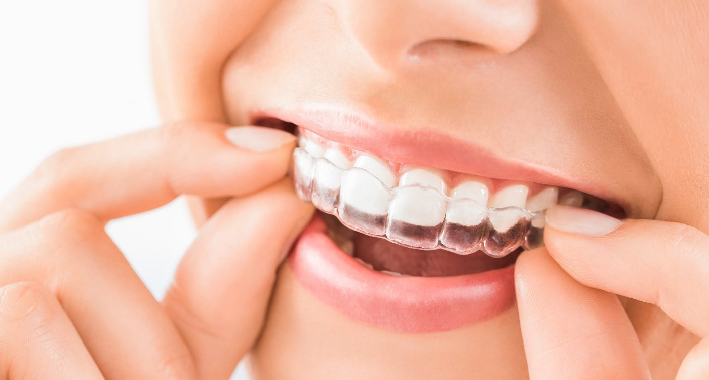 Clear Aligner Costs: Balancing Affordability with Professional Supervision