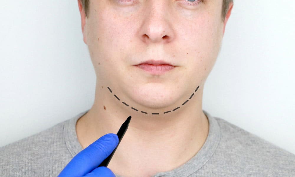 Láser para Eliminar Papada Sin Cirugía: Tratamiento No Invasivo para Hombres y Mujeres