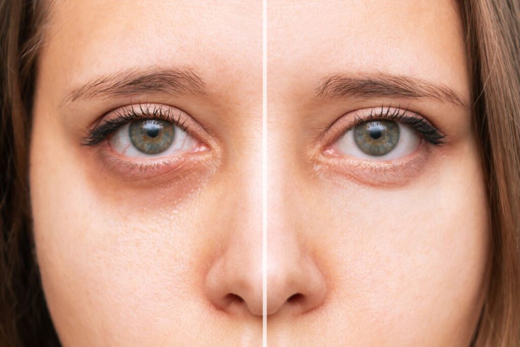 Laser Under-Eye Treatment: A Complete Guide to Dark Circles, Puffiness, and Aging Skin