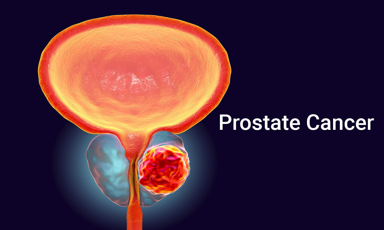Advanced Prostate Cancer Treatments: Hormone Therapy, Chemotherapy, Immunotherapy, and Emerging Options
