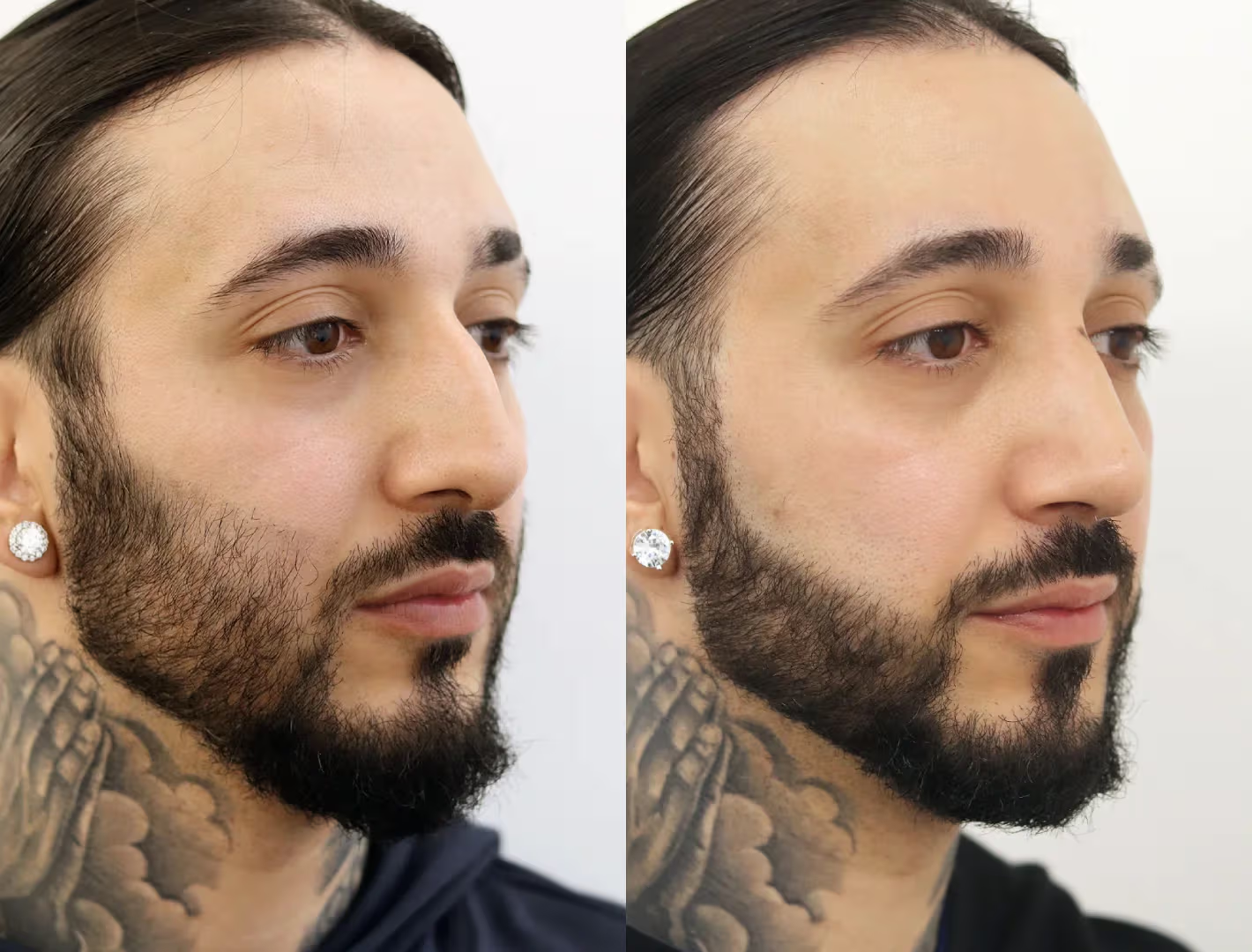 The Complete Guide to Male Rhinoplasty: Strong Profile, Better Breathing, Natural Results