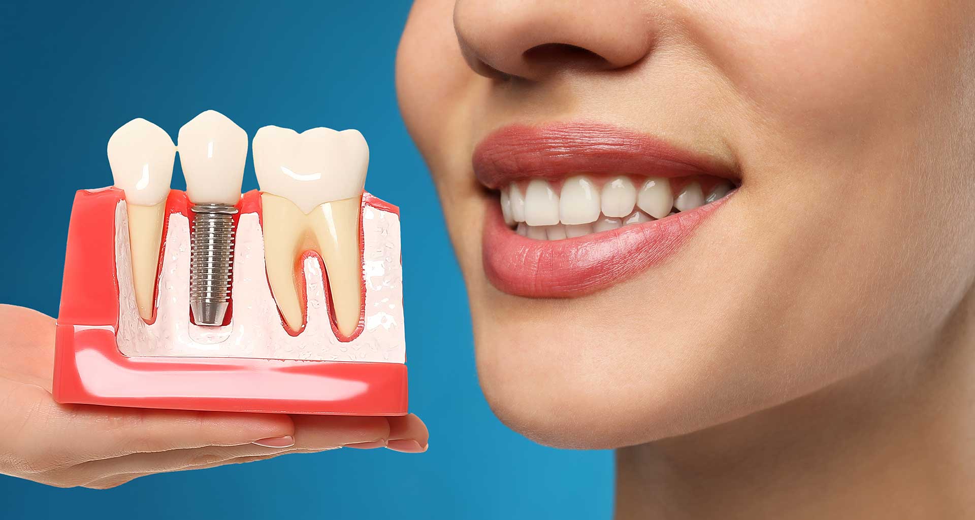 Implant dentaire en France : prix, étapes, remboursement et devis – Guide complet