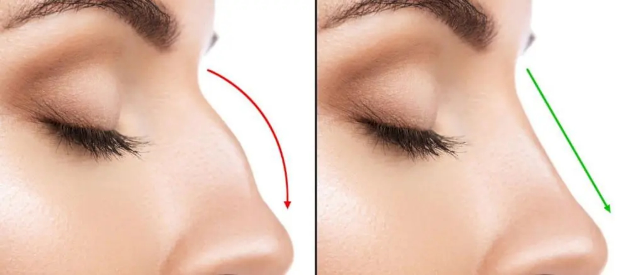 تجميل الأنف: دليل شامل للجراحة والحلول غير الجراحية واختيار الجراح المثالي