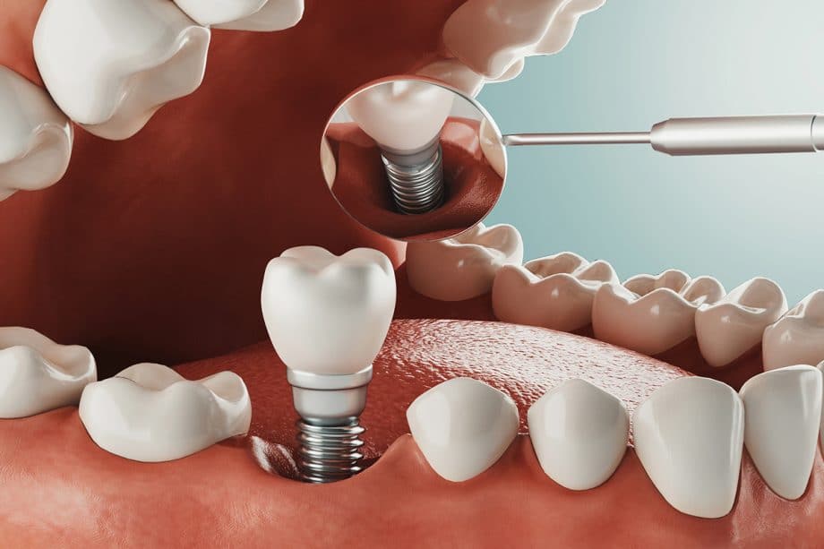 Impianti Dentali: Guida Completa a Tipologie, Vantaggi, Costi e Cura
