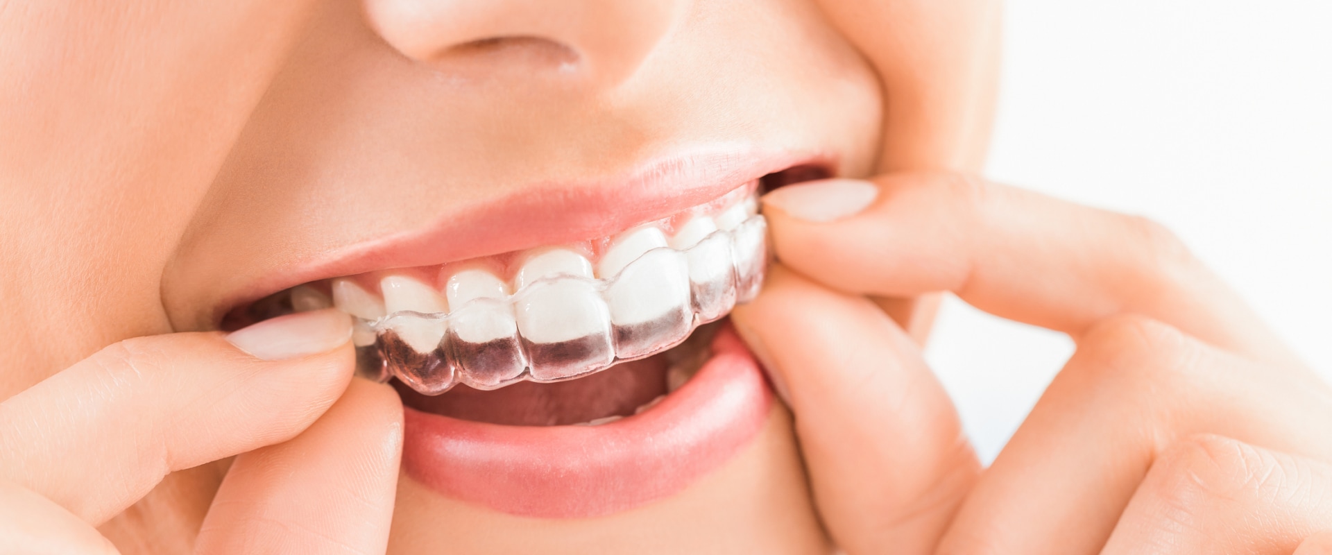 Invisalign Guide: Benefits, Cost, Comparison with Braces & How It Works