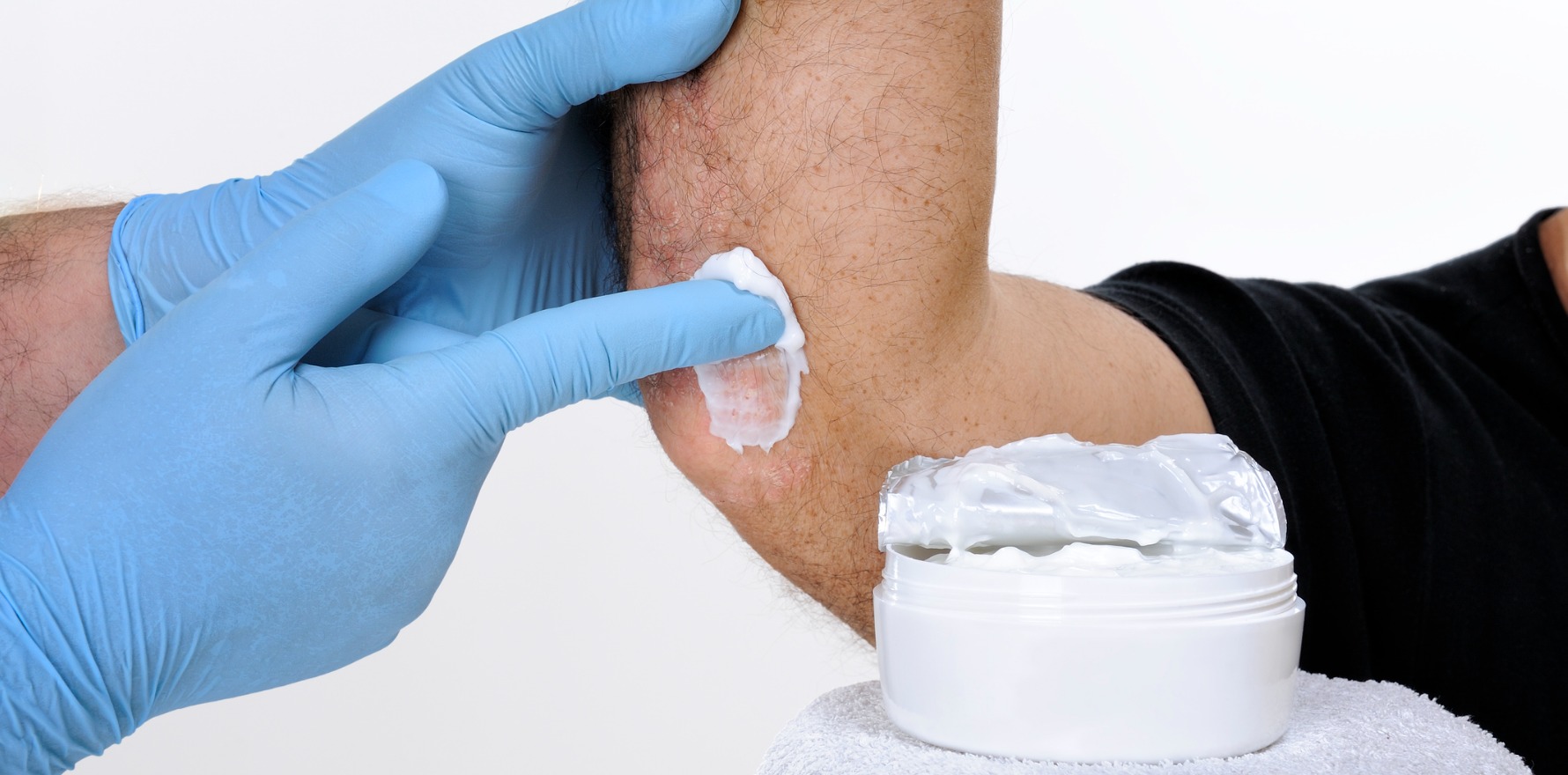 Psoriasis Guide: Triggers, Symptoms, Types, and Management Strategies