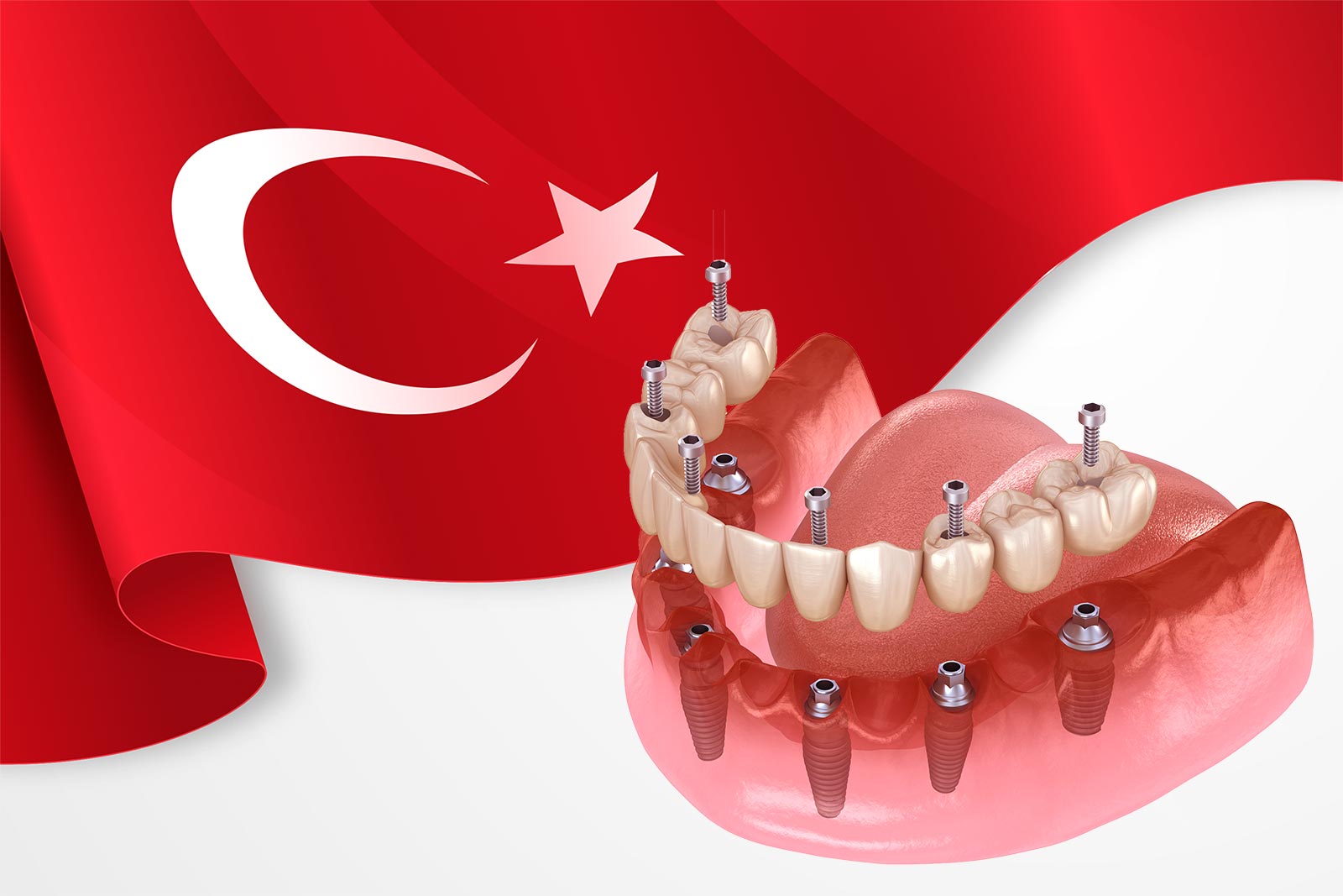 Dental Implants in Turkey: Why UK Patients Choose Turkish Clinics for Affordable Care