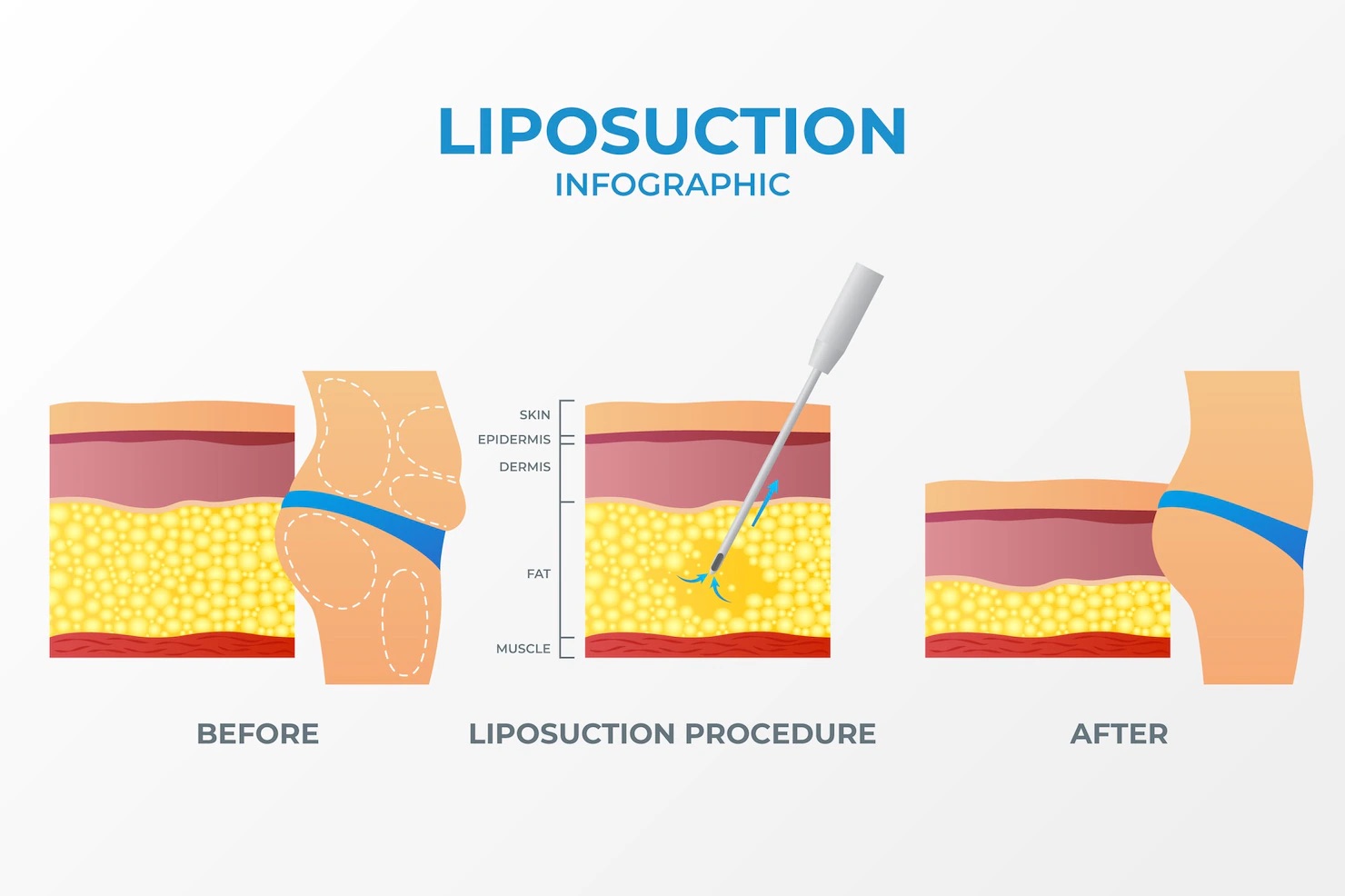 Liposuction UK 2024: Costs, Types & Non-Surgical Alternatives