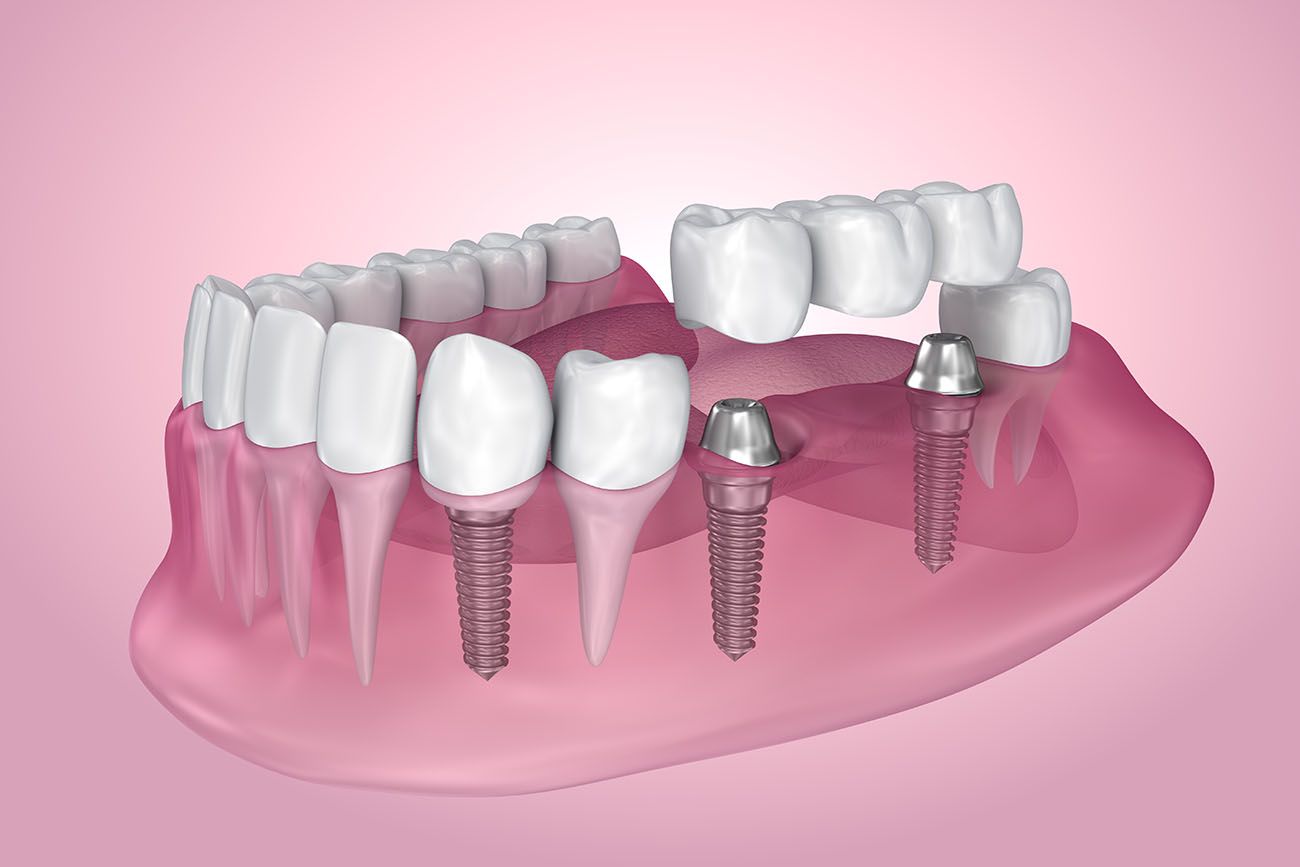 Complete Dental Implant Guide: Procedure, Costs, Senior Benefits & Workplace Programs
