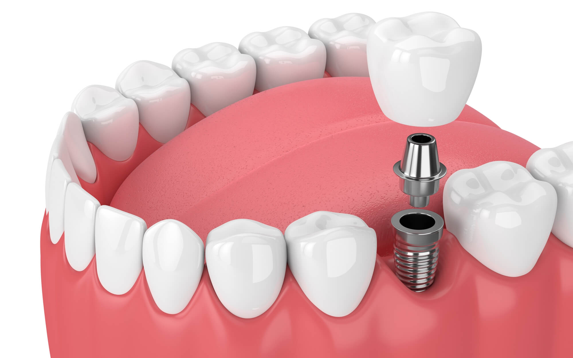 Dental Implants: Your Complete Guide to Procedure, Costs, and Choosing a Local Expert